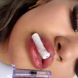 Needless Lip FillER! 