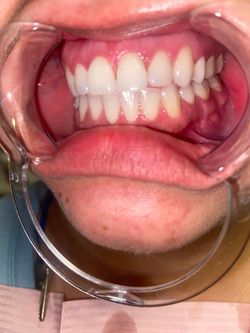 Teeth Whitening By MC