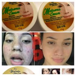 2 Melasma Cream Whitening Acne Dark Pimples and Melasma