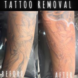 Removal