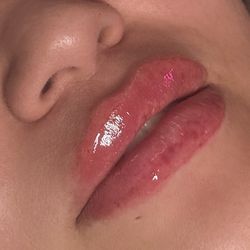Lip Fillers 