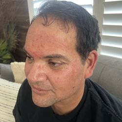 Micro needling facial w/ Salmon DNA