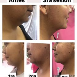 Reducción de Papada SIN Cirugía