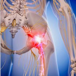 The Sciatica Eliminator E-Book 