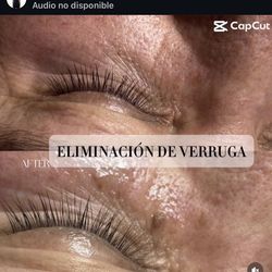 Eliminación de verrugas