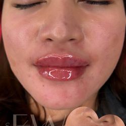 Lip Filler 👄