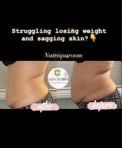 Body Sculpting / Contouring