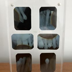 Handmade Teeth X-ray Acrylic Frame