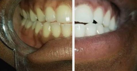 Deep cleaning & Teeth whitening