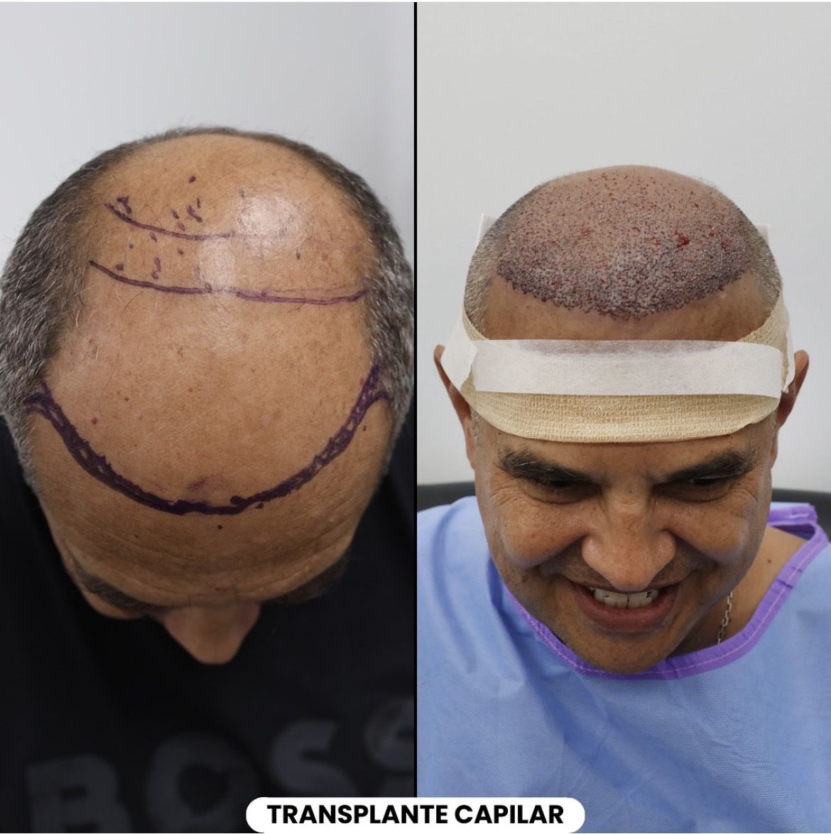 Hair Implant