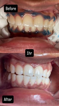 Teeth Whitening