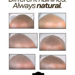 Scalp Micropigmentation In San Diego | Restore Your Hairline 