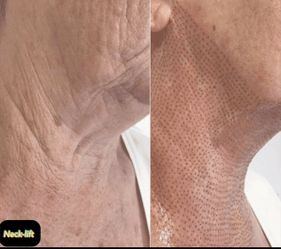 Neck Lift