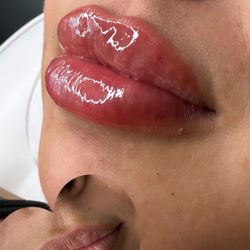Lip Filler ✨💋