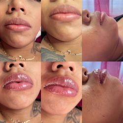 Hyaluronic Fillers