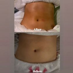 Before And After 1 Ultra Cavitation & RF