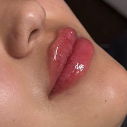 Lip Fillers 