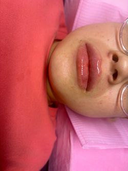 Lip filler/injections