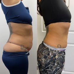 Body sculpting Machine 