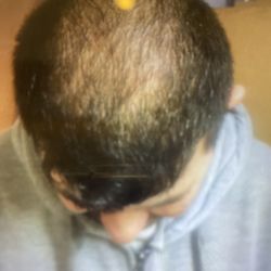 Producto Para La Caída Del Pelo