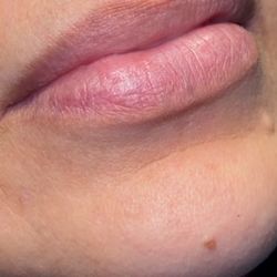 Lip Filler Needless