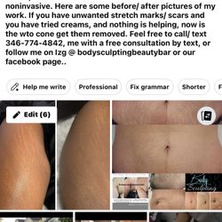 Stretch Mark/ Scars Removal