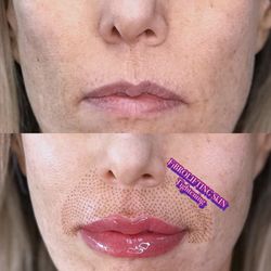 Skin Tightening 