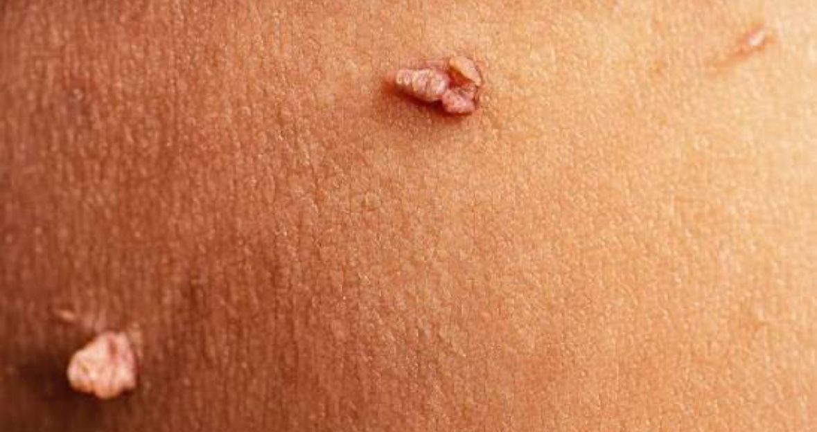 Skin Tag Removals 