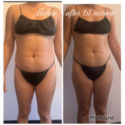 Body sculpting