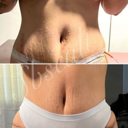 Post Op Lymphatic Supplies Care