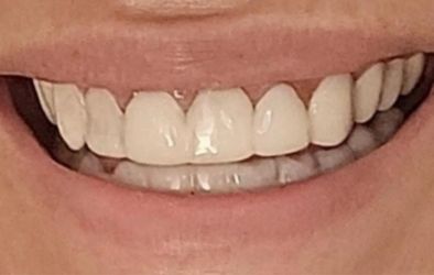 Click-On Smile Veneers