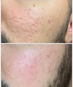 Plasma Fibroblasto Varios Tratamiento