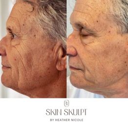 Plasma  Skin rejuvenates device