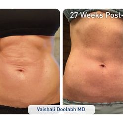 Freee Slim Tightening 