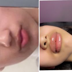 Hyaluron Lip Filer