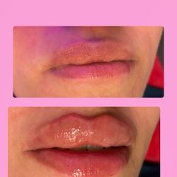 Fillers