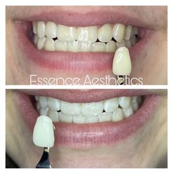 Teeth Whitening
