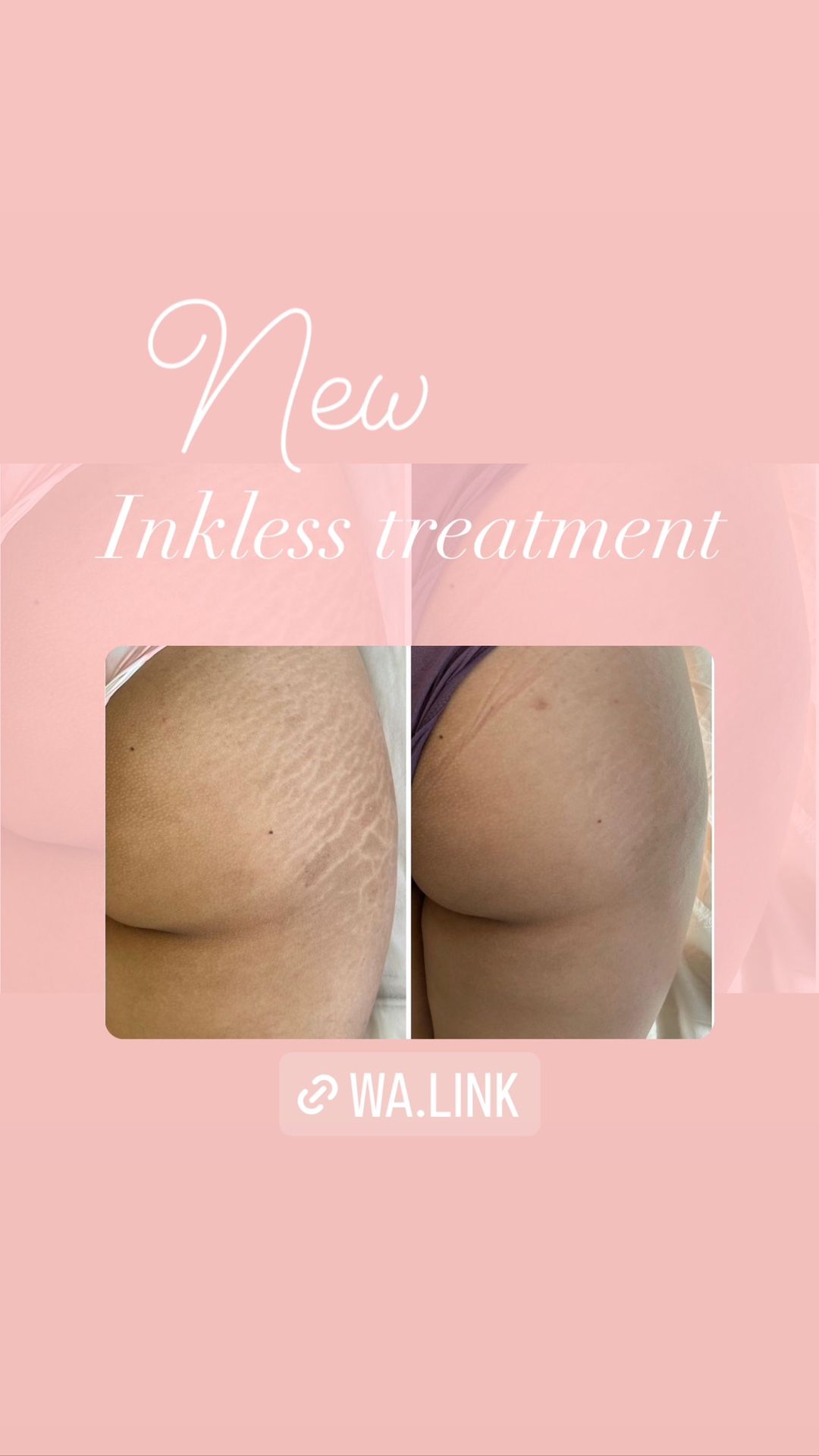 strech marks REMOVAL