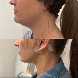 Lymphatic/ Post-Op Supplies