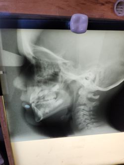 Xrays
