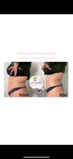 Body Sculpting Treatments
