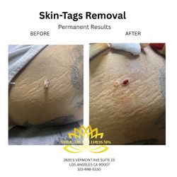 Remove Skin tags or moles