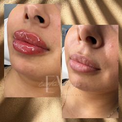 Plump Lips ✨👄💉