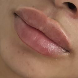 Lip Fillers  and More