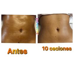 Maderoterapia Corporal 