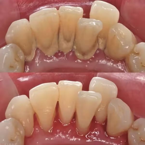 Low Cost Dental Cleanings