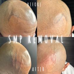 Removal
