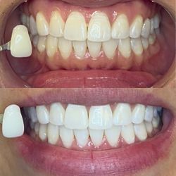 Blanqueamiento De Dientes