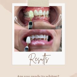 Cosmetic Teeth Whitening