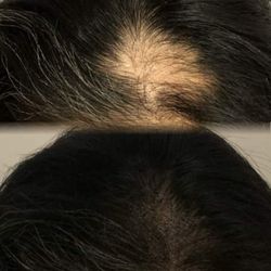 SMP - Scalp Micropigmentation 